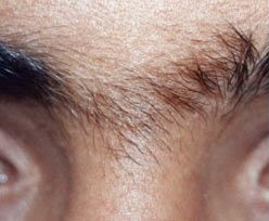 Laser Hair Removal 1