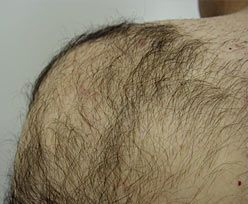Laser Hair Removal 2 1