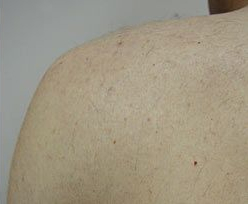 Laser Hair Removal 2 2