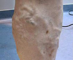 Laser Skin Treatments - Endovascular Laser Ablation 1