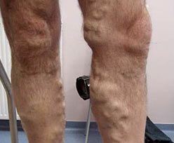Laser Skin Treatments - Endovascular Laser Ablation 2 1