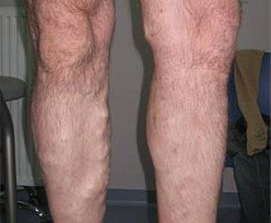 Laser Skin Treatments - Endovascular Laser Ablation 2 2