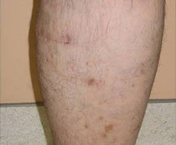 Laser Skin Treatments - Endovascular Laser Ablation 2