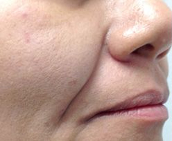 Laser Skin Treatments - Facial Line Reduction 1