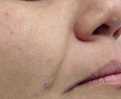 Laser Skin Treatments - Facial Line Reduction 2