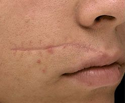Laser Skin Treatments - Facial Scar Treatment 1