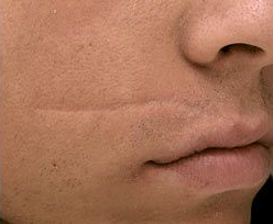 Laser Skin Treatments - Facial Scar Treatment 2