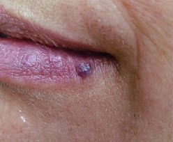 Laser Skin Treatments - Hemangioma Treatment 1