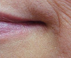 Laser Skin Treatments - Hemangioma Treatment 2