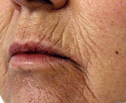 Laser Skin Treatments - Perioral Resurfacing Treatment 1