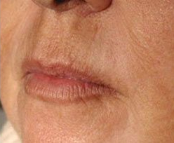 Laser Skin Treatments - Perioral Resurfacing Treatment 2