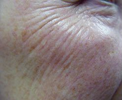 Laser Skin Treatments - Resurfacing Treatment 1