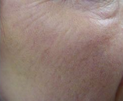Laser Skin Treatments - Resurfacing Treatment 2