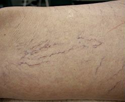 Laser Skin Treatments - Spider Vein Removal 1