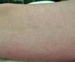 Laser Skin Treatments - Spider Vein Removal 2