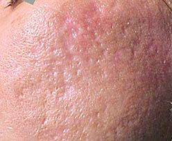 Skin Treatments - Acne Scars Treatment 1