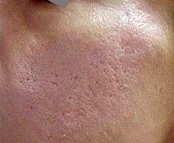 Skin Treatments - Acne Scars Treatment 2