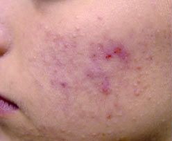 Skin Treatments - Active Acne Treatment 1