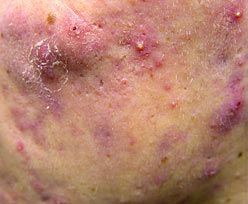 Skin Treatments - Active Acne Treatment 2 1