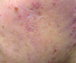 Skin Treatments - Active Acne Treatment 2 2