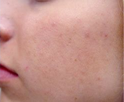 Skin Treatments - Active Acne Treatment 2