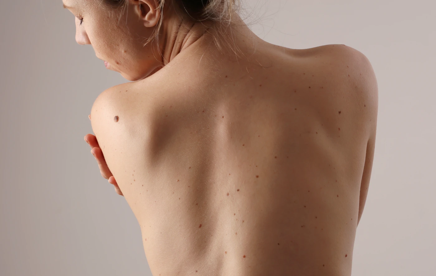 Benign Lesions