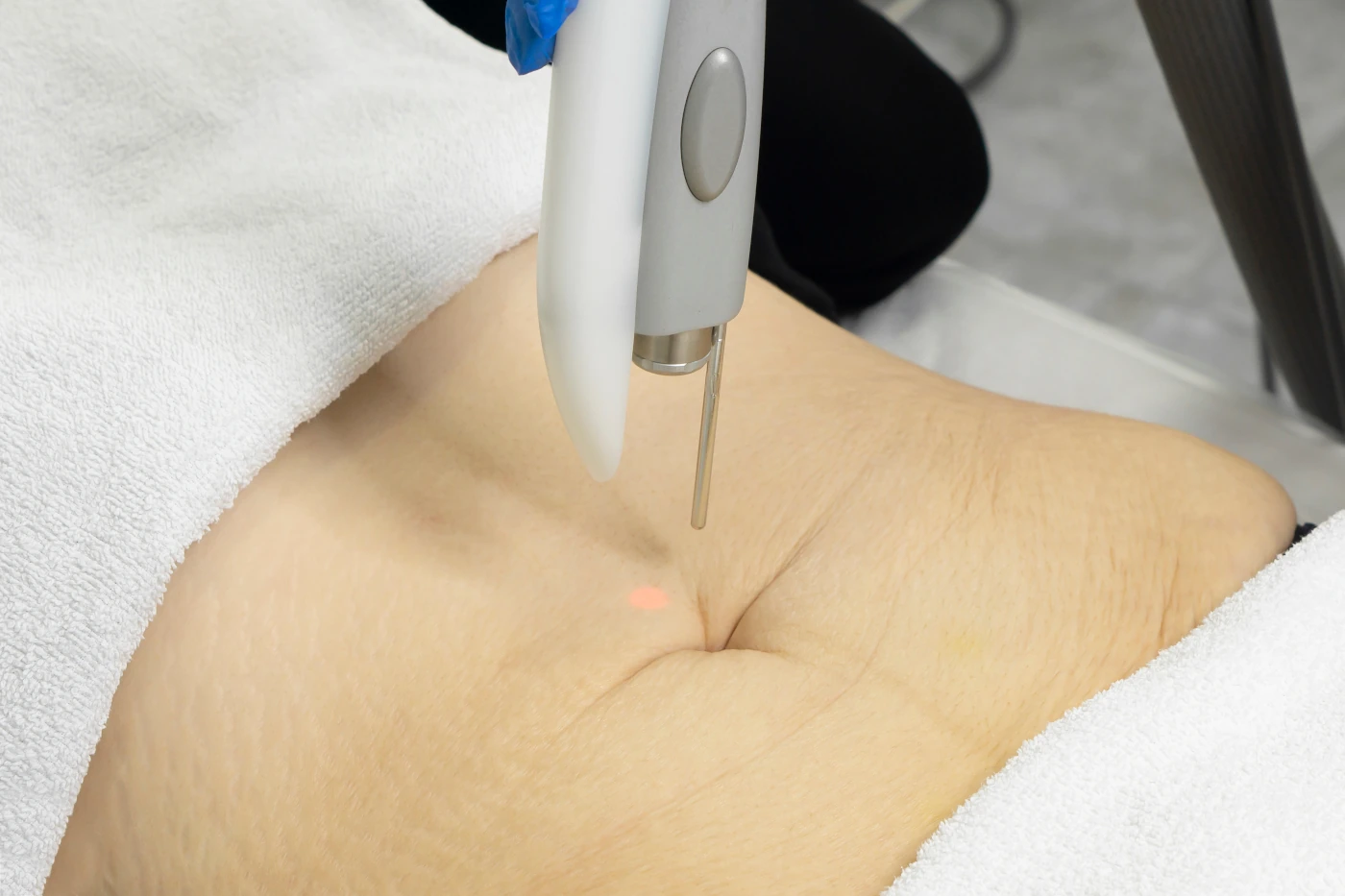 Skin Tightening