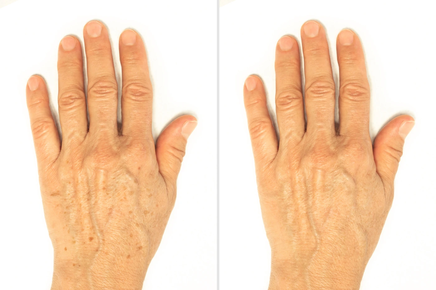 Hand Rejuvenation
